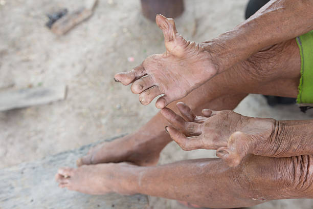 hansen” s disease, grande plano mãos do velho homem com lepra - 600 imagens e fotografias de stock