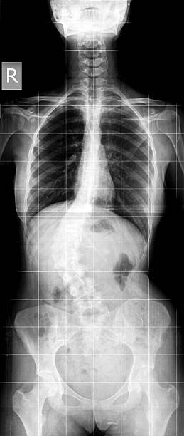 istock Scoliosis X-ray image 523167231
