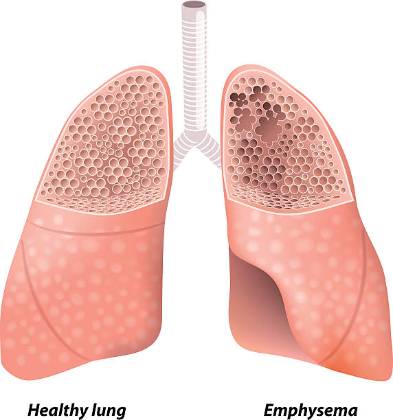 Chronic obstructive pulmonary disease Emphysema. Chronic obstructive pulmonary disease. diagram showing a cross-section of normal lung and lungs damaged by COPD. Human anatomy alveolus stock illustrations