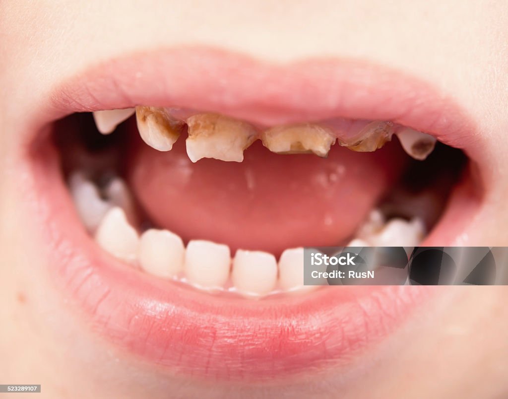 uthealthy teeth close up of unhealthy baby teeth Child Stock Photo