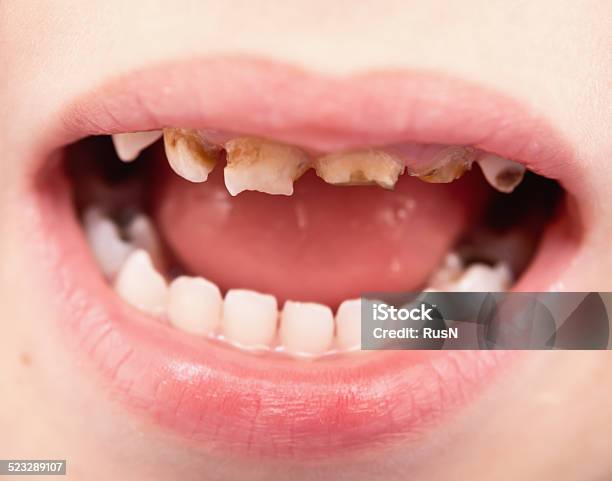 Uthealthy Teeth Stock Photo - Download Image Now - Child, Dental Cavity, Human Teeth