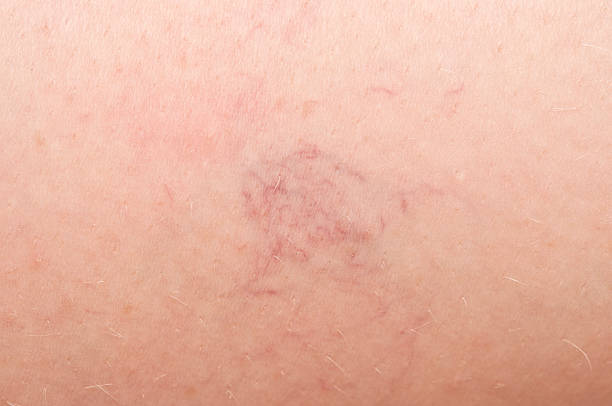 istock varicose veins on the skin. Macro 523358811