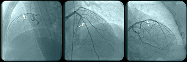 istock Coronary artery disease 523405340