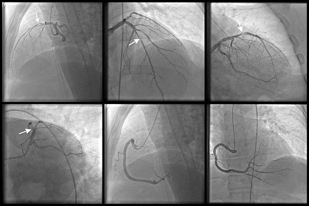 kranzschlagader krankheit - human heart heart attack x ray image chest stock-fotos und bilder