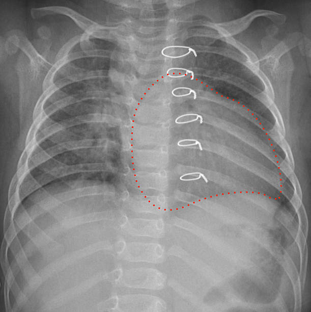 Roentgenogram of the chest in a child after cardiac surgery X-ray of the chest in a child who underwent cardiac surgery for congenital heart disease. Severe enlarged heart is marked by dotted line scar surgery rear view human spine stock pictures, royalty-free photos & images