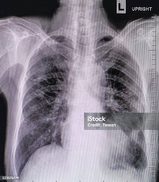 Neumonía Prueba De Barrido Radiografía Detalles Modernos De Rayos X Foto de stock y más banco de imágenes de Abstracto