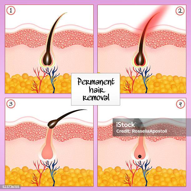 Ilustración de Depilación Permanente y más Vectores Libres de Derechos de Depilación con cera - Depilación con cera, Belleza, Calvo