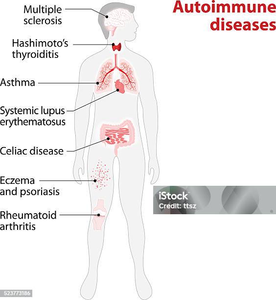 Les Tissus Du Corps Humain Touchées Par Autoimmune Attack Vecteurs libres de droits et plus d'images vectorielles de Rhumatisme articulaire