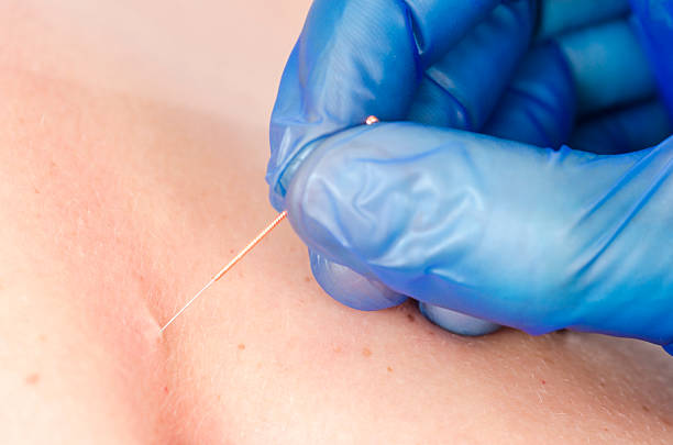 istock Needle and hands of physiotherapist doing a dry needling. 523826842