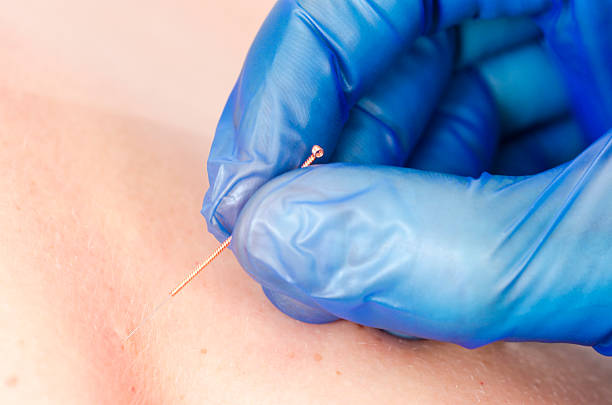 istock Needle and hands of physiotherapist doing a dry needling. 523827192