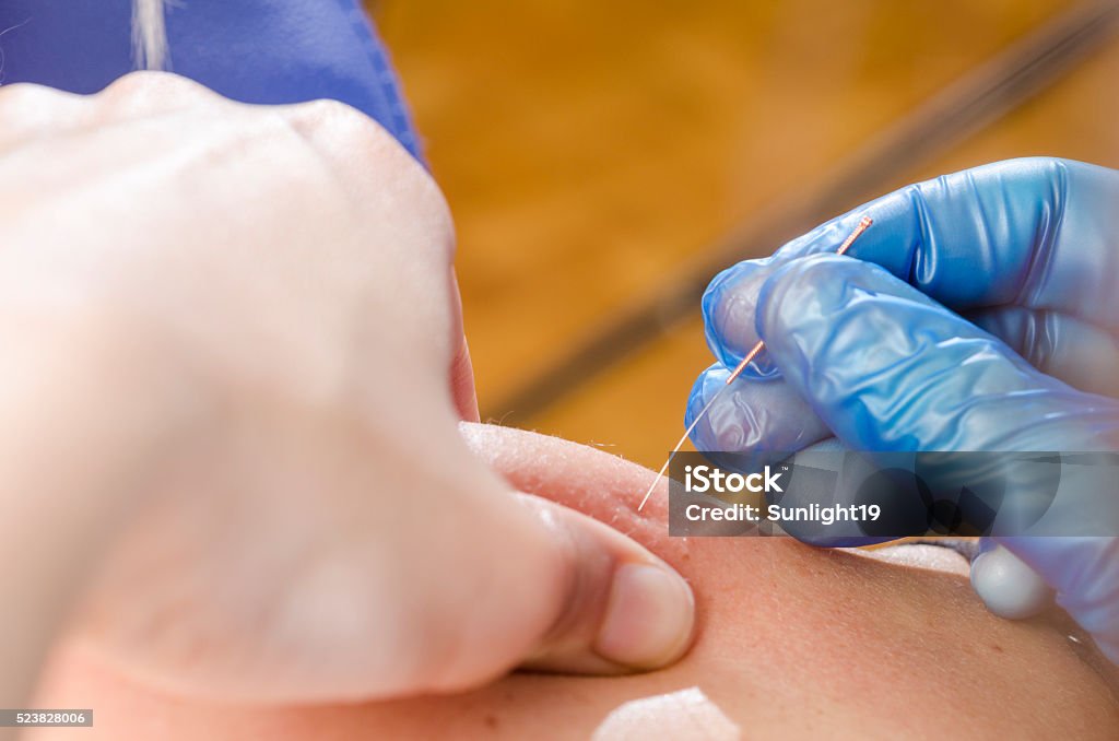 Needle and hands of physiotherapist doing a dry needling. Closeup of a needle and hands of physiotherapist doing a dry needling. Dry Stock Photo