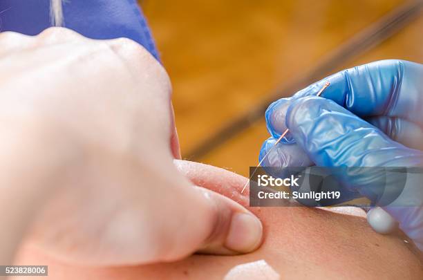 Needle And Hands Of Physiotherapist Doing A Dry Needling Stock Photo - Download Image Now