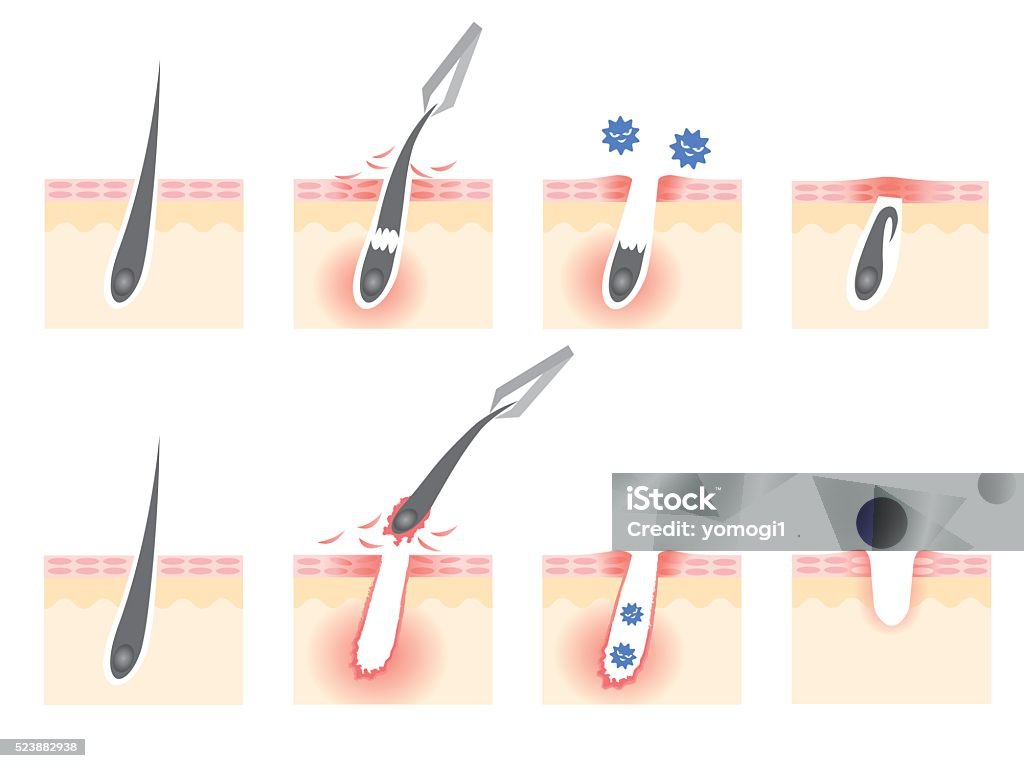 Tweezers Hair Removal Stock Illustration - Download Image Now - Bacterium,  Beautician, Colors - iStock