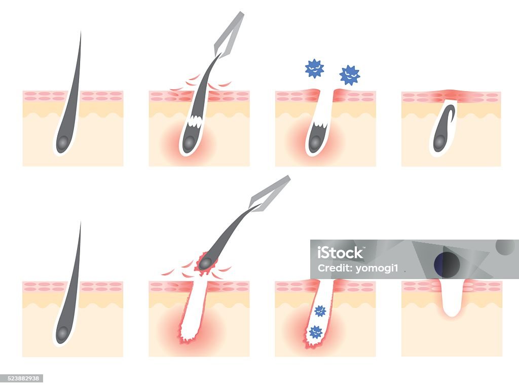 Tweezers Hair Removal Stock Illustration - Download Image Now - Bacterium, Beautician, Colors - iStock Tweezers Hair Removal Stock Illustration - Download Image Now - Bacterium, Beautician, Colors - iStock