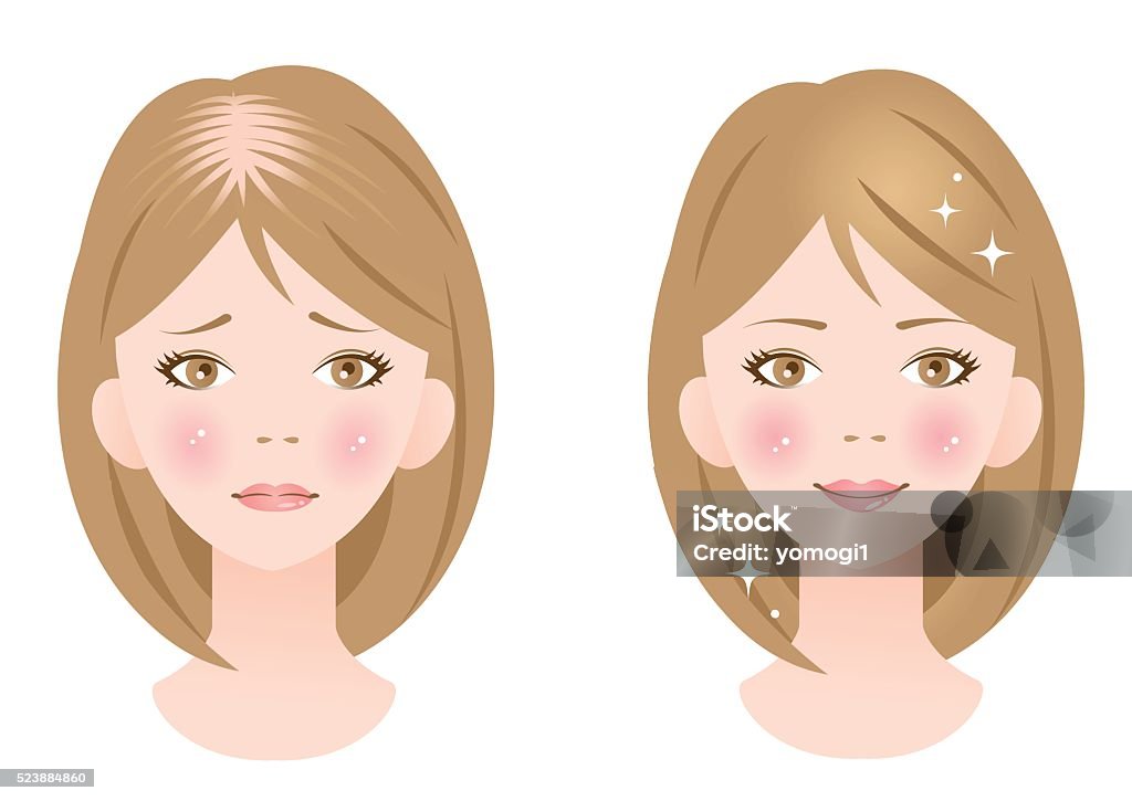 healthy hair woman and hair loss woman healthy and beautiful hair woman with a smile and thinning hair and hair loss with troubled expression. Hair Loss stock vector