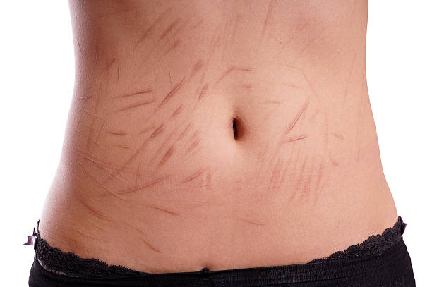 scars from deliberate self-harm female tummy with scars from deliberate self-harm self harm photos stock pictures, royalty-free photos & images