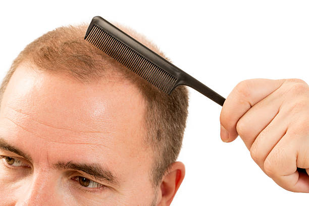 istock Baldness Alopecia man hair loss isolated 524147908