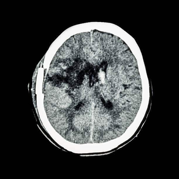 istock old right basal ganglia hemorrhage ( status post craniotomy ) 524167358