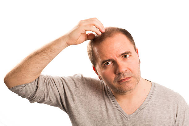 istock Baldness Alopecia man hair loss isolated 524547662