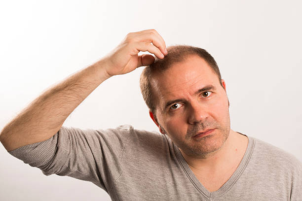 istock Baldness Alopecia man hair loss isolated 524547836