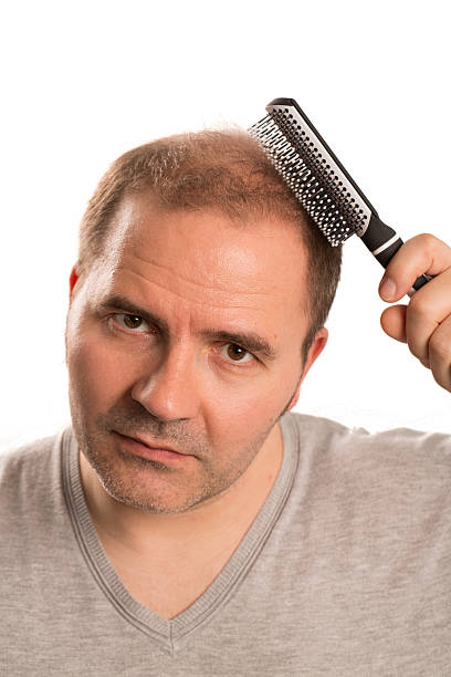 istock Baldness Alopecia man hair loss isolated 524548010