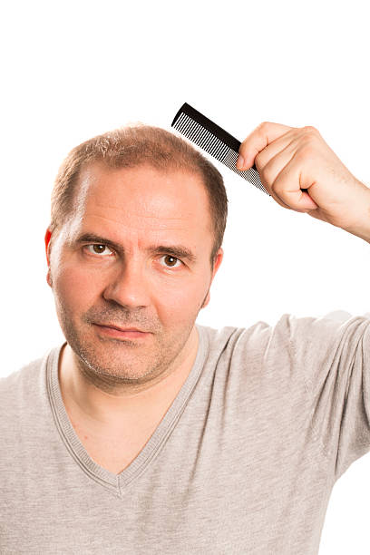 istock Baldness Alopecia man hair loss isolated 524548484