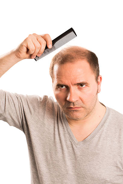 istock Baldness Alopecia man hair loss isolated 524548622