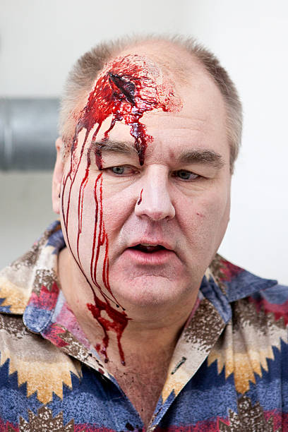 istock Senior man with head injury - laceration 524576911