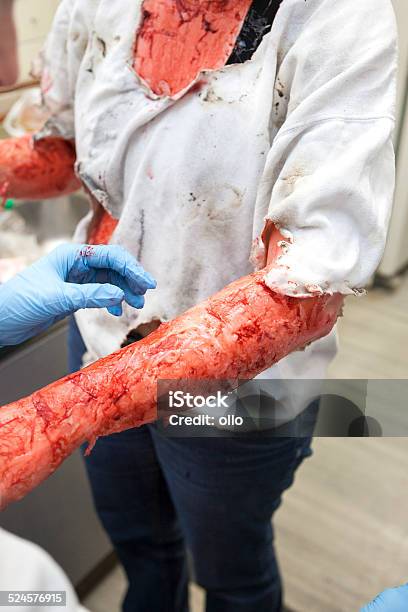 Efectos Especiales Hacen De Artistas Tirita Para Quemaduras Foto de stock y más banco de imágenes de Quemar