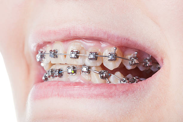dental steel klammern am zahn nahaufnahme - fehlbiss stock-fotos und bilder