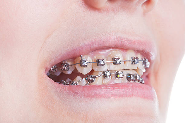 istock orthodontic braces on teeth close up 524856349