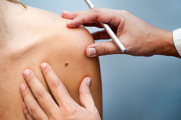 birthmark A medical consultation at the Removal of nevus. complexion stock pictures, royalty-free photos & images