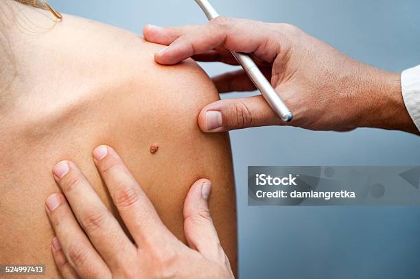 Birthmark Stock Photo - Download Image Now - Melanoma, Mole - Skin, Dermatology