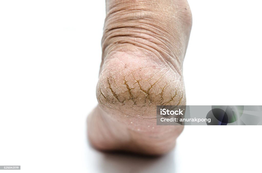 Close up  of Cracks on  Heels Close up  of Cracks on  Heels isolated white background Adult Stock Photo
