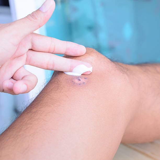 istock Treatment for scar on leg. 525043354