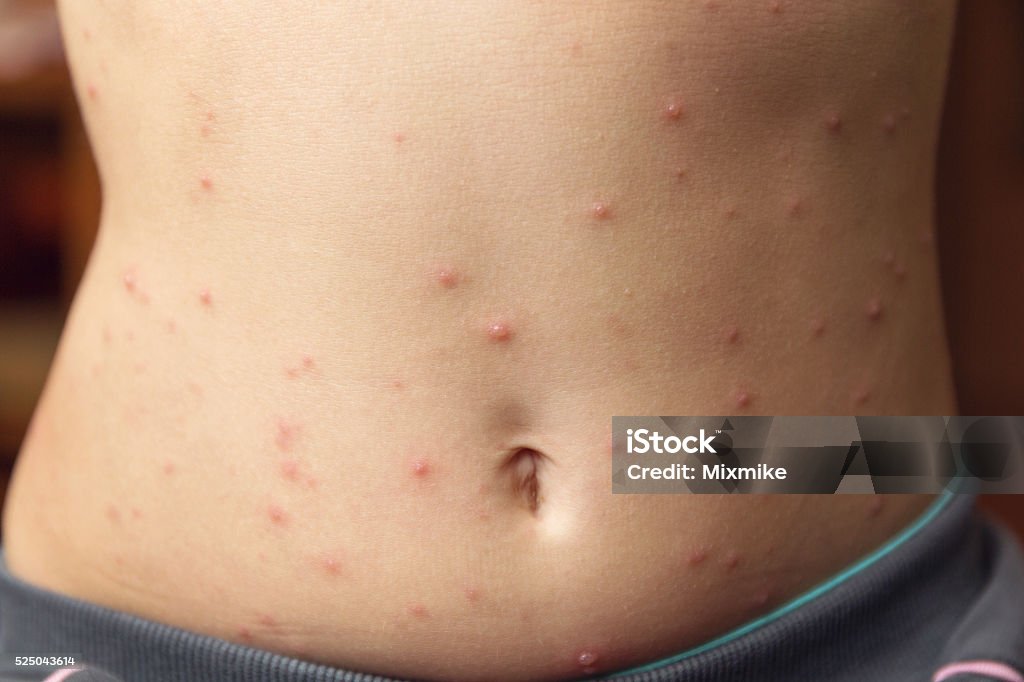 Varicella disease Little girls tummy covered with chickenpox / varicella pimples Shingles Stock Photo