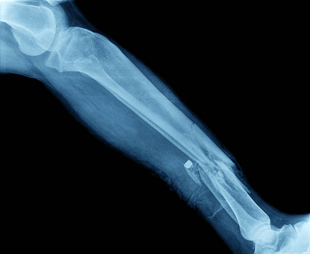 Broken leg Broken tibia annd fibula Xray femur photos stock pictures, royalty-free photos & images