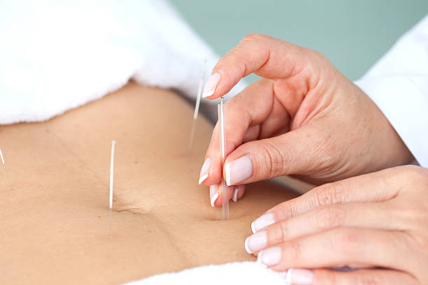 istock Doctor applying acupuncture on a patient's abdomen 525230858