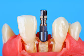 dental-audiosystem-implanted-in-jaw.jpg?b=1&s=170x170&k=20&c=7eY41wWhQ7HAiqbNr3ohiI2bQhmzo4sBNSvBRwaONbw=