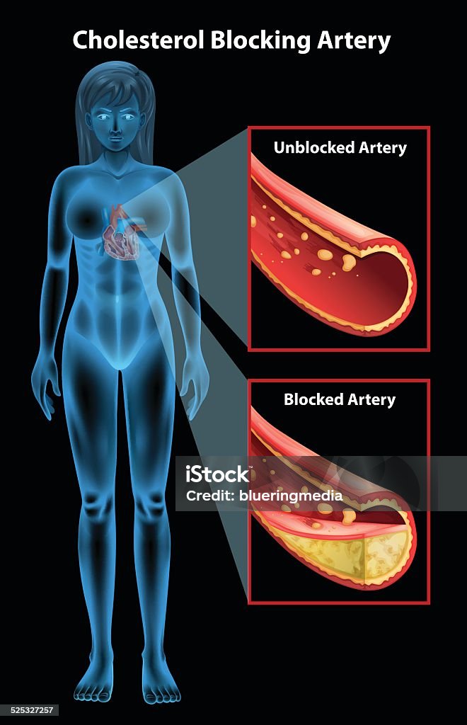 Ateriosclerosis Showing the process of ateriosclerosis Aggression stock vector