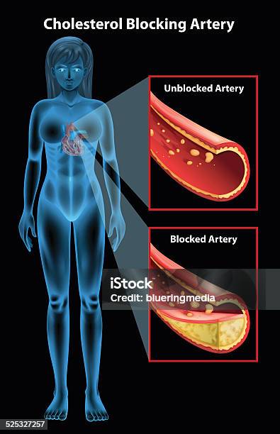 Ateriosclerosis Stock Illustration - Download Image Now - Aggression, Angioplasty, Atherosclerosis
