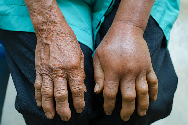 left hand inflammation from the green pit viperb snake bite left hand inflammation from the green pit viperb snake bite swelling on hands stock pictures, royalty-free photos & images
