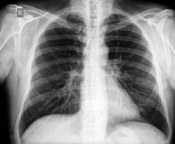radiografia del torace - human lung asthmatic x ray human internal organ foto e immagini stock