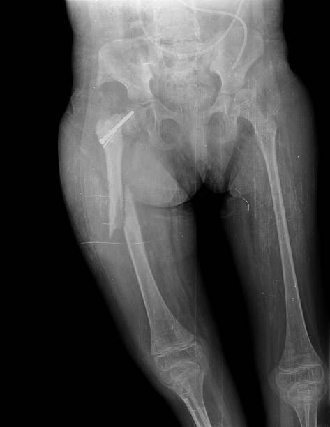 istock xray of child hip and broken leg 525496457