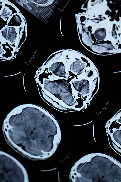CT and MRI of the skull stock photo