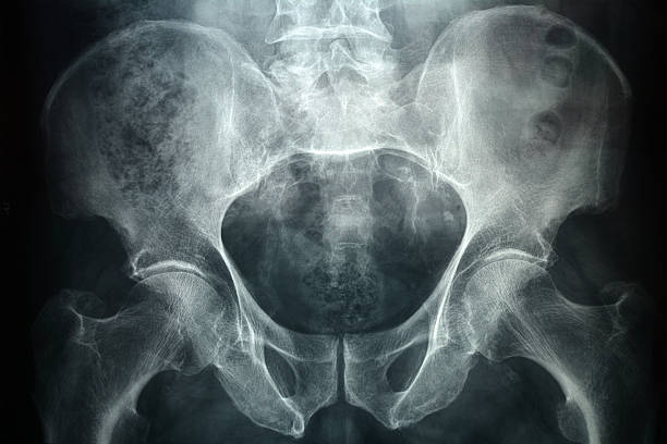 Pevic xray Xray of a male pelvic, it's a high resolution 24 mp photo not a scan. rectum stock pictures, royalty-free photos & images