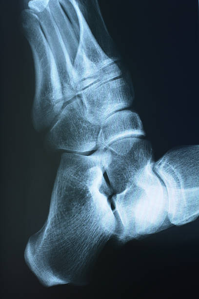 pé xray - bending human foot ankle x ray image - fotografias e filmes do acervo