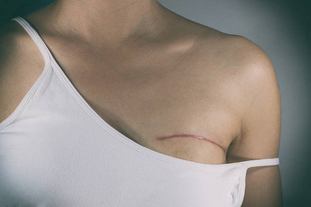 Breast cancer surgery scars Breast cancer surgery scars by partial mastectomy. With effect filter. breast cancer stock pictures, royalty-free photos & images
