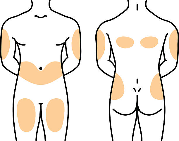 Insulin injection sites Available in high-resolution and several sizes to fit the needs of your project. insulin stock illustrations