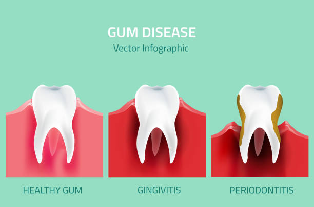 Gum disease stages. Teeth infographic Teeth infographic. Gum disease stages. Editable vector illustration in modern style. Medical concept in natural colors on a light green background. Keep your teeth healthy periodontitis stock illustrations